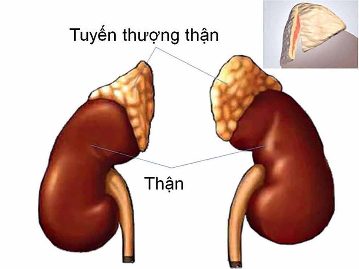 Bệnh cường aldosterol nguyên phát là một rối loạn nội tiết tố dẫn đến huyết áp cao