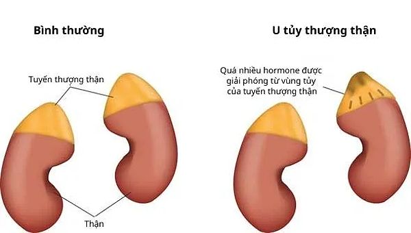 Bệnh U tủy thượng thận là gì? Nguyên nhân, triệu chứng và hậu quả