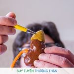 Ung Thư Đại Tràng Di Căn Tuyến Thượng Thận