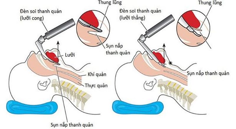 Quy trình gây mê nội khí quản