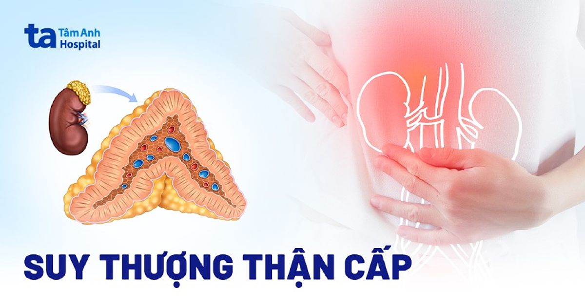 Suy thượng thận cấp tính