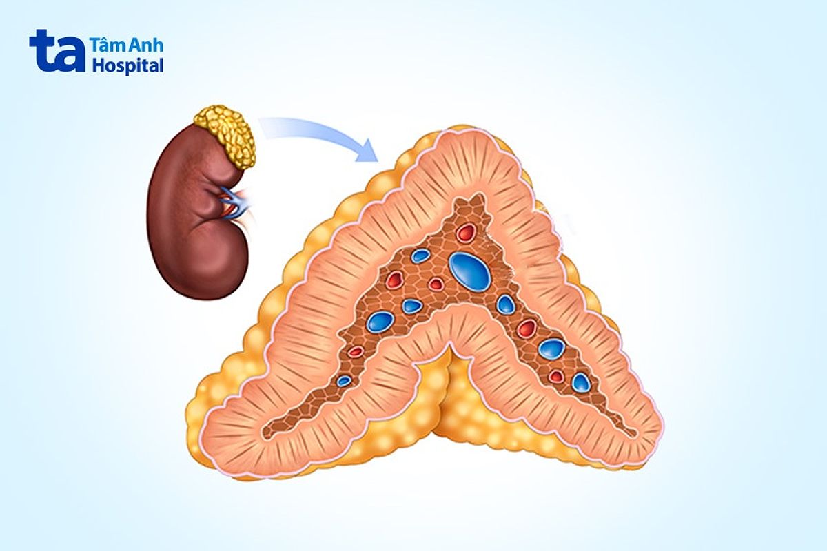 Suy thượng thận cấp tính xảy ra do không đủ cortisol