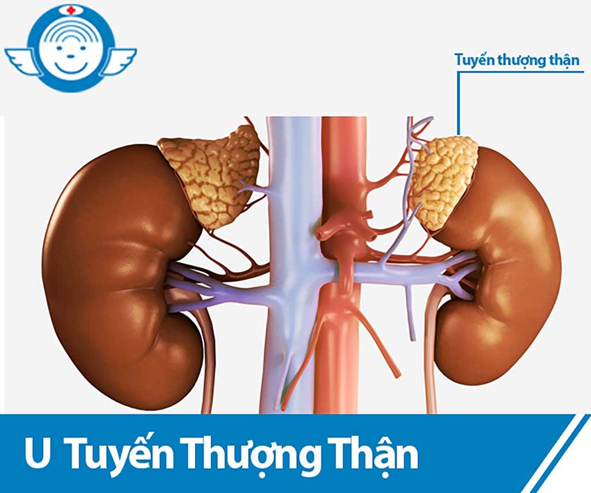 Nguyên Nhân, Triệu Chứng Và Điều Trị U Tuyến Thượng Thận Gây Hạ Kali Máu