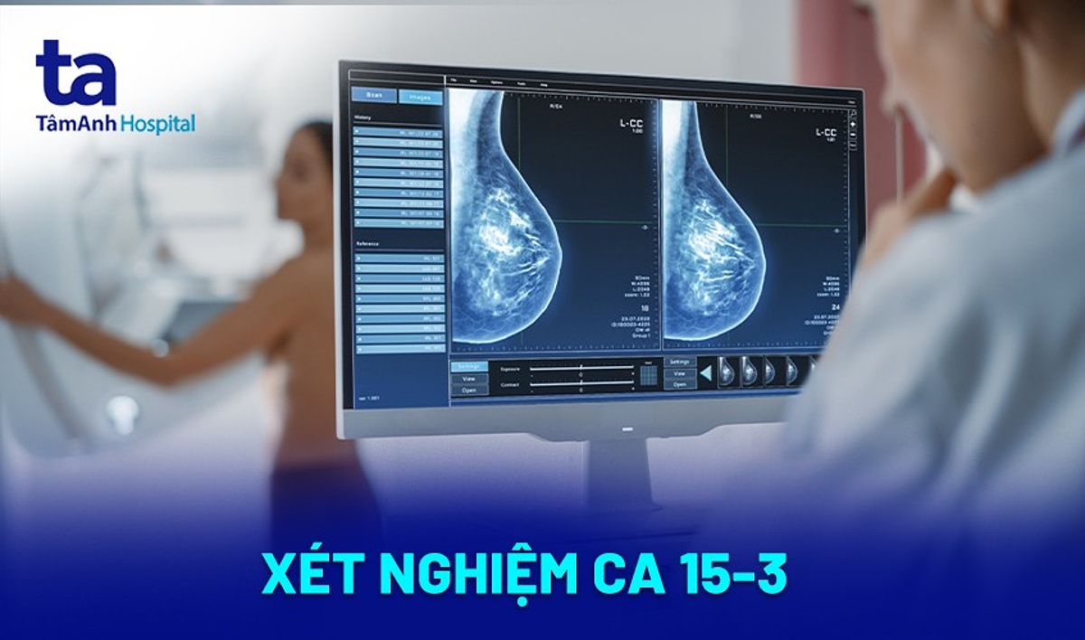 Xét nghiệm CA 15-3